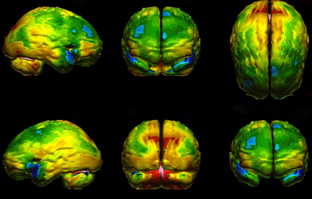 Schizophrenia and Cannabis-Use Found to be Drivers of Brain Aging